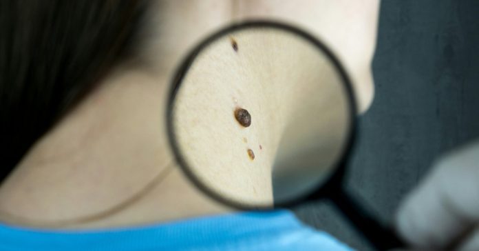 Carcinoma espinocelular: o que &eacute; e como tratar esse c&acirc;ncer