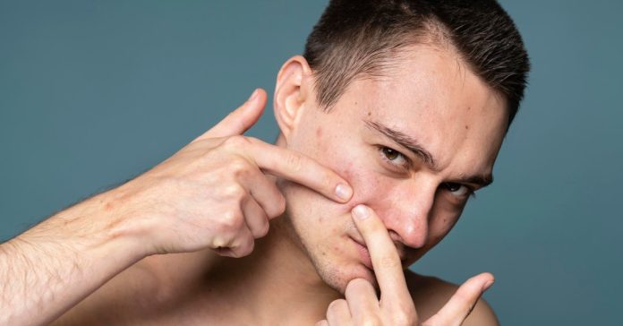 P&uacute;stulas ou espinhas? Entenda as diferen&ccedil;as e conhe&ccedil;a os